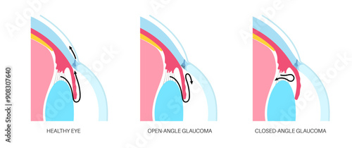 Glaucoma eye disease