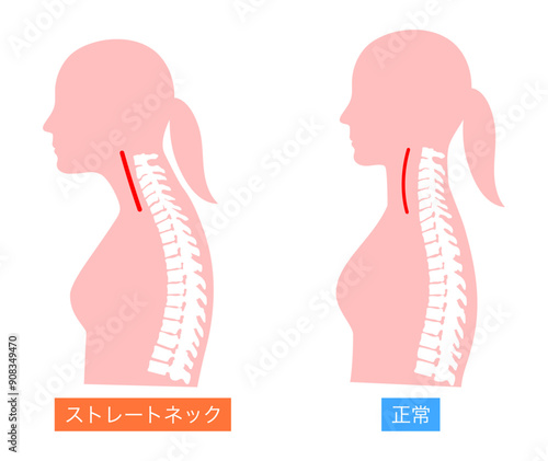 正常とストレートネックの女性の上半身の比較説明イラスト