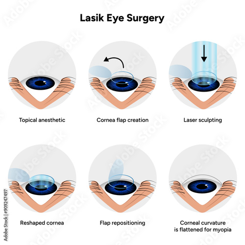 Lasik eye surgery steps procedure 