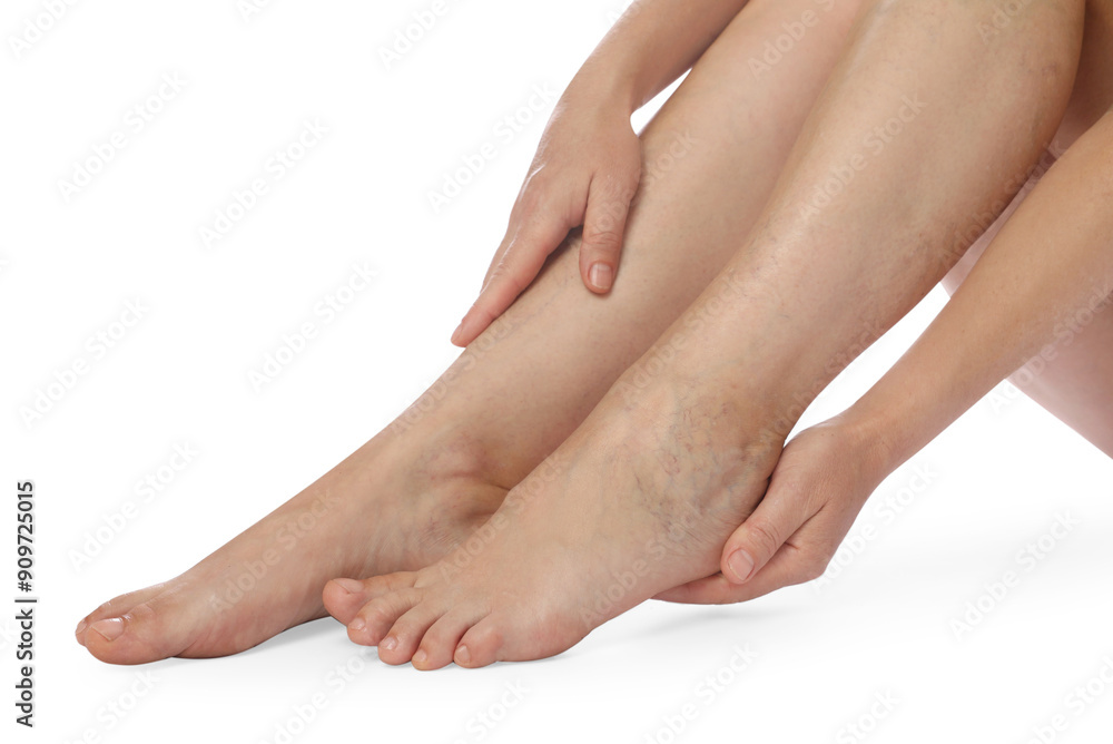 Woman suffering from varicose veins on white background, closeup Woman suffering from varicose veins on white background, closeup