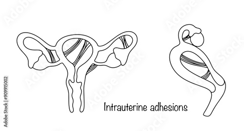 Intrauterine adhesions