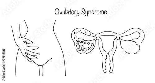 Ovulatory Syndrome