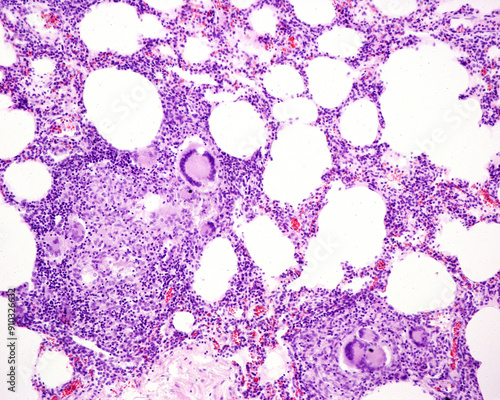 Human lung. Tuberculosis. Langhans giant cells photo