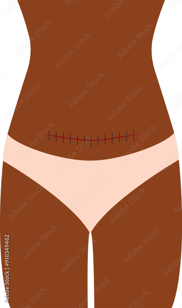 Woman Proudly Showing Her C Section Vector Cartoon Illustration. Postpartum body of a new mom with love scar Woman Proudly Showing Her C Section Vector Cartoon Illustration. Postpartum body of a new mom with love scar