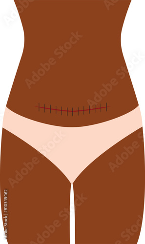 Woman Proudly Showing Her C Section Vector Cartoon Illustration. Postpartum body of a new mom with love scar