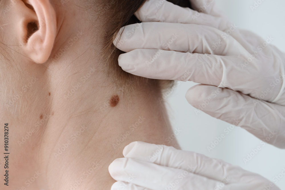 Fototapeta premium Doctor examining woman's mole in clinic, closeup