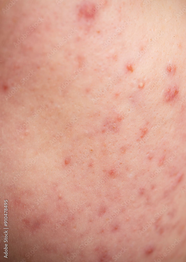 Fototapeta premium Skin texture background. Closeup acne pimple. Treatment for skin. Problem skincare. Pimples, acne, pores, scars. Natural skin. Skin care concept. Acne treatment. Pimples on face. Acne and pimple on