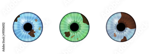 Iris melanoma anatomy