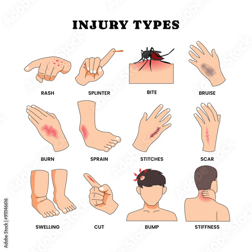 Different types of physical injury types poster for education vocabulary words with rash, splinter, bite, bruise, burn, sprain, stitches, scar, swelling, cut, bump and stiffness. Wounds and fractures.