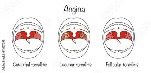 Angina