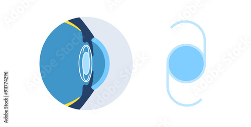 Intraocular lens poster