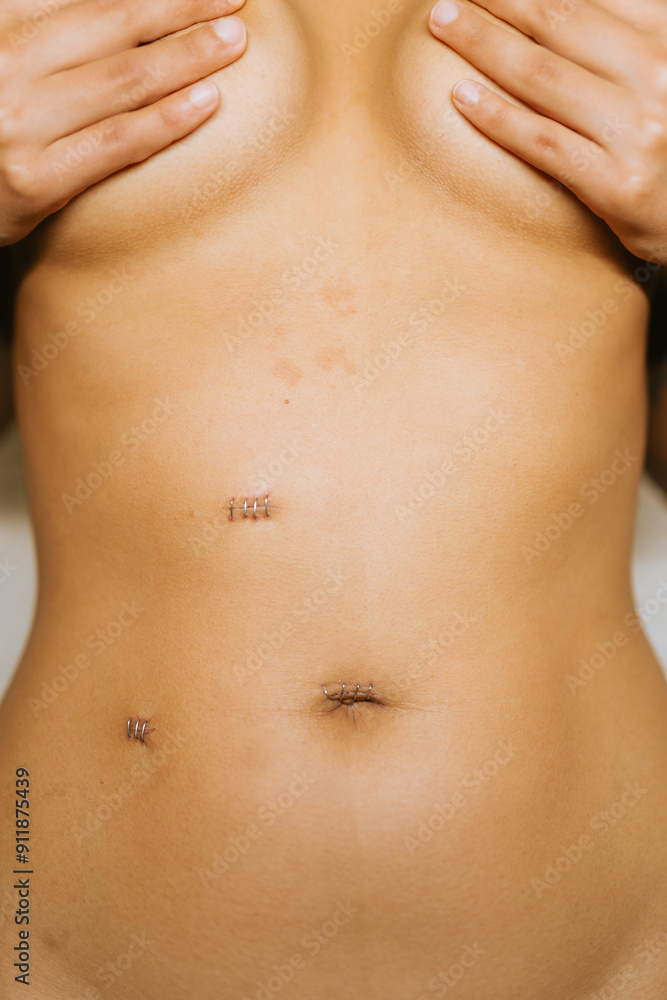 Laparoscopic Surgery Scars Laparoscopic Surgery Scars