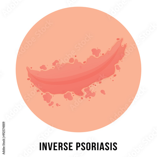 Illustration of inverse psoriasis with its appearance on the body