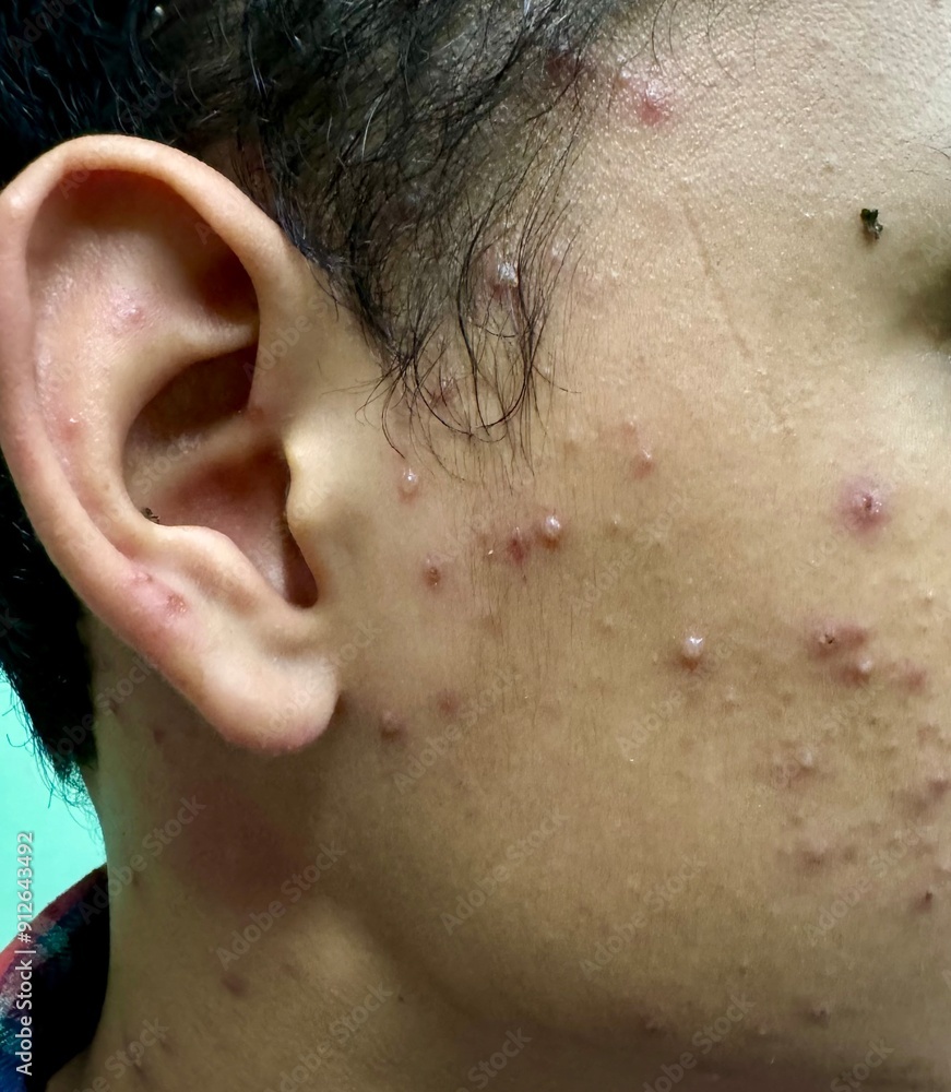 Naklejka premium Chicken pox infection at face.