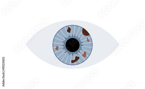 Iris melanoma anatomy