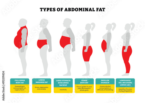 Different types of abdominal fat set collection, body fat healthcare poster design with detail description, labeled human belly, lower, stomach, legs. Unhealthy lifestyle, Weight loss diet concept.