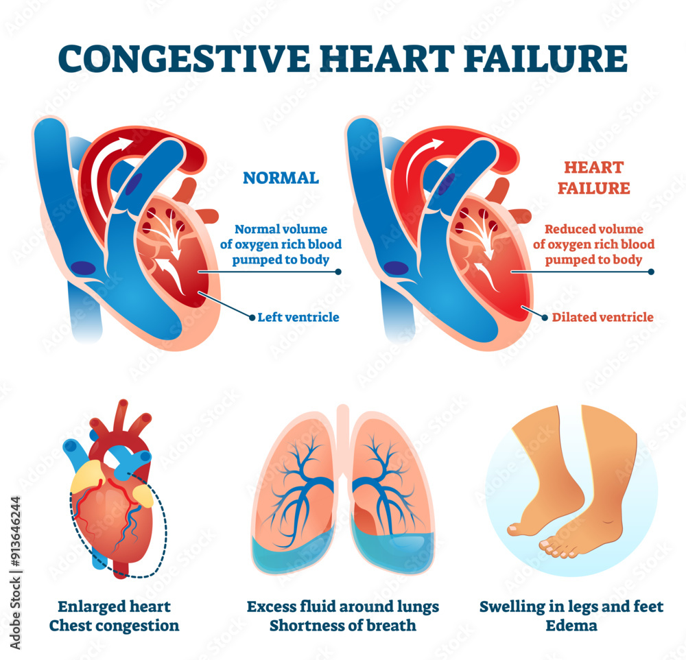Congestive heart failure illustration, transparent background. Labeled
