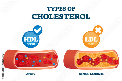 Types of cholesterol comparison with HDL and LDL lipoprotein illustration, transparent background. Labeled educational normal and narrowed artery cross section explanation.