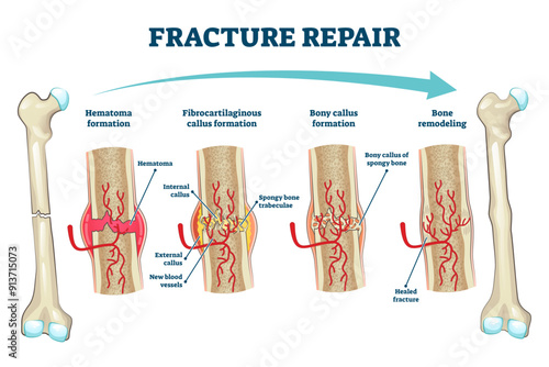 Fracture repair as educational bone remodeling and formation stages illustration, transparent background. Labeled structure and hematoma healing process description from physiology and anatomy aspect.