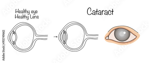 Cataract