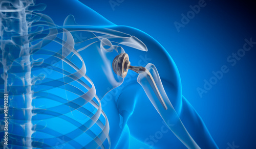 Shoulder joint replacement implant - X-ray view - Medically 3D illustration with blue background