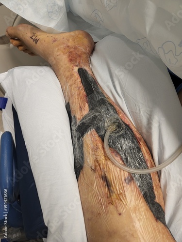 Vacuum wound dressing in place after surgical debridement