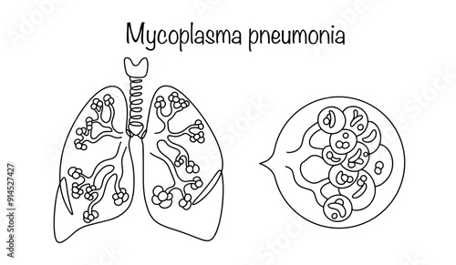 Mycoplasma pneumonia