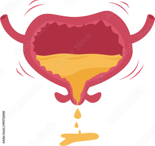 Urinary bladder disease. Urinary incontinence Illustration. 