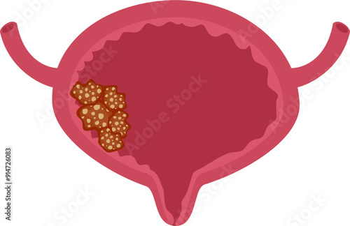 Urinary bladder disease.Bladder cancer Illustration.