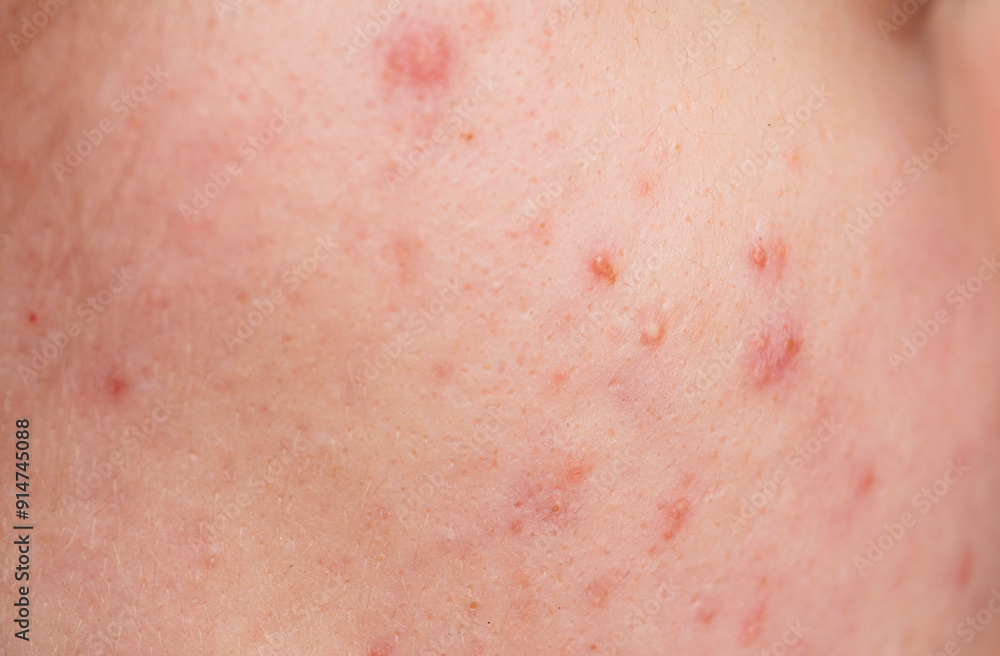 Skin texture background. Closeup acne pimple. Treatment for skin. Problem skincare. Pimples, acne, pores, scars. Natural skin. Skin care concept. Acne treatment. Pimples on face. Acne and pimple on Skin texture background. Closeup acne pimple. Treatment for skin. Problem skincare. Pimples, acne, pores, scars. Natural skin. Skin care concept. Acne treatment. Pimples on face. Acne and pimple on