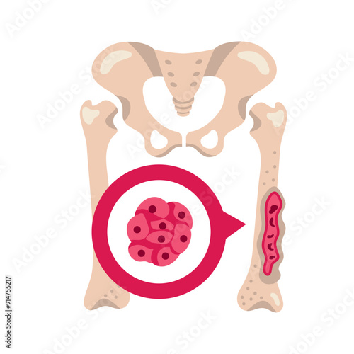 multiple myeloma is a cancer of the bone marrow