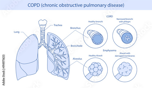COPD infographic: manifests itself in two forms emphysema and bronchitis