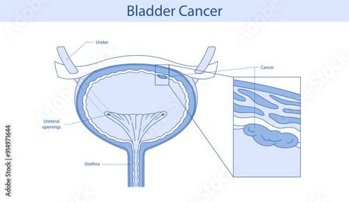 Anatomy of the bladder. Diagram of cancer disease. Vector  illustration is hand drawn.