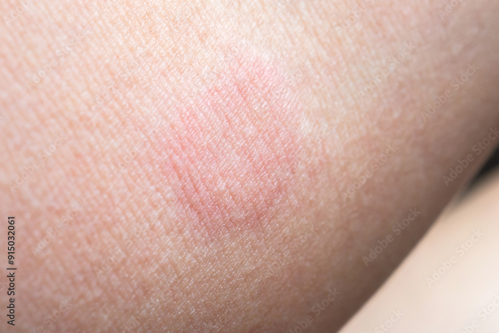 Fototapeta premium Skin allergy rash dermatitis texture close up