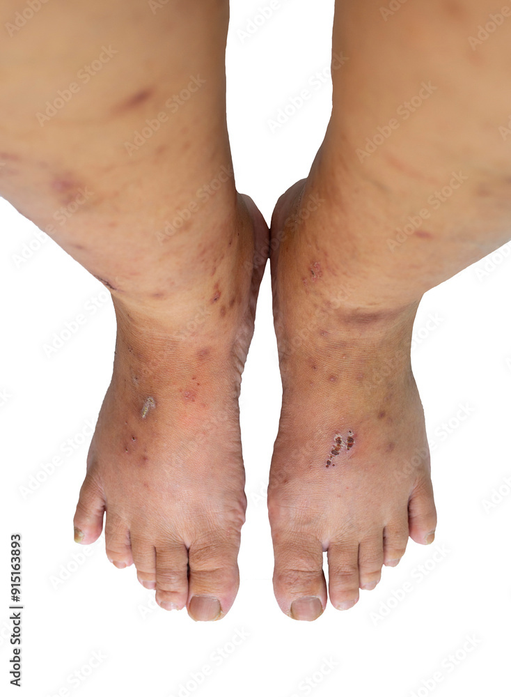 Transparent PNG Skin diseases and skin wounds on the legs and feet of a person isolated on white background Transparent PNG Skin diseases and skin wounds on the legs and feet of a person isolated on white background