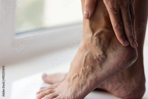 Woman gently touching her foot with large swollen veins. 