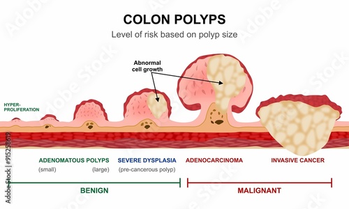 Photos Colon Polyps Cancer Illustration