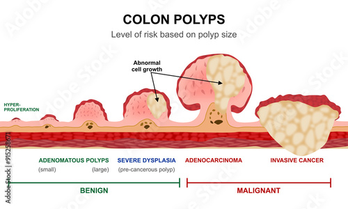 Colon Polyps Cancer Illustration