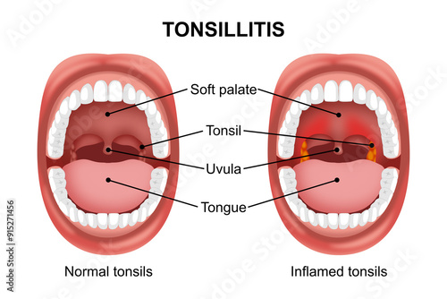 Tonsillitis in mouth illustration infection