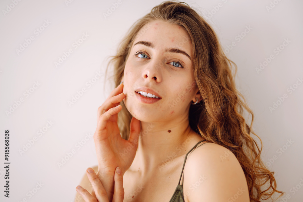 Fototapeta premium Portrait of a beautiful young woman with inflammations on the skin of her face. Pimples. Acne disease. Medicine and cosmetology. 