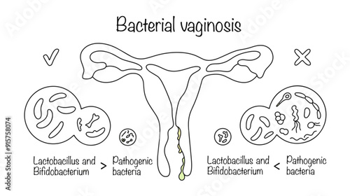 Bacterial vaginosis