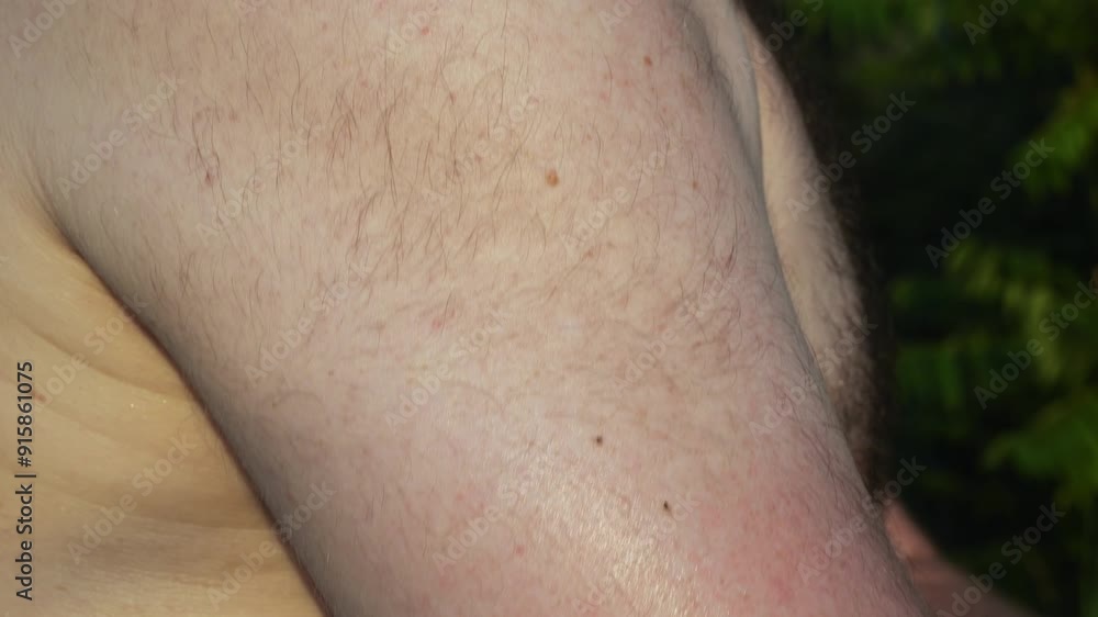 Red irritated skin on the upper arm with a hand touching the affected area. Close-up photography for medical and dermatology concepts
Red irritated skin on the upper arm with a hand touching the affected area. Close-up photography for medical and dermatology concepts