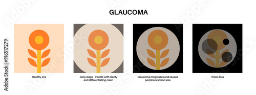 Glaucoma eye disease