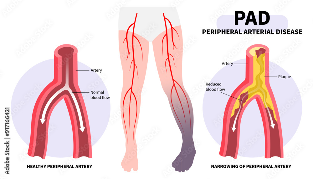 Foot pain with Peripheral artery disease and fatty clot in leg veins or injury that cause high blood pressure