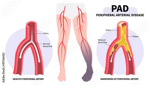Foot pain with Peripheral artery disease and fatty clot in leg veins or injury that cause high blood pressure