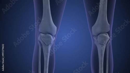 Chronic patella pain syndrome animation