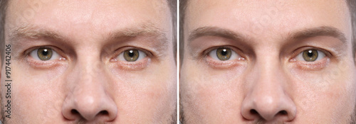 Man before and after permanent eyebrow procedure, collage with closeup photos photo