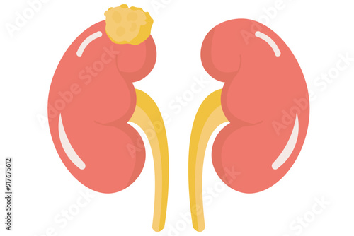 Kidney cancer starts in the kidneys. Similar diseases include renal cell carcinoma, Wilms tumor, and transitional cell carcinoma. It affects kidney function and may spread,red