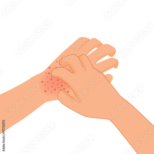 hand scratching itchy hand with allergic rash skin

