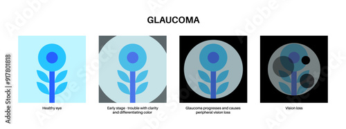 Glaucoma eye disease